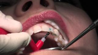 Composite Fillings [upl. by Nyrat347]