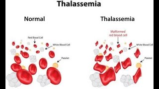 Thalassemia in Hindi [upl. by Oderfla]