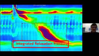 Oesophageal dysmotility cases  simplifying manometry interpretation  Dr M Scriba [upl. by Frodeen777]