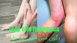 Deep vein thrombosis رگون میں خون جم جانا [upl. by Lindeberg]