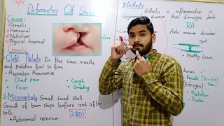 Deformities Of Skeleton By Hadi  Cleft Palate Microcephaly Osteoporosis Class 12 In Urdu Hindi [upl. by Isabelle]