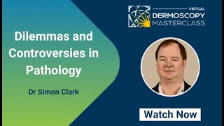 Dilemmas and Controversies in Pathology  Dr Simon Clark  Virtual Dermoscopy Masterclass 2020 [upl. by Kristy]