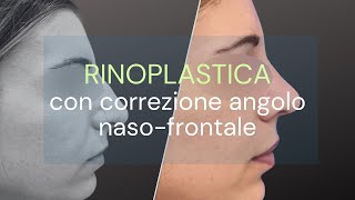 Rinoplastica con correzione dellangolo nasofrontale [upl. by Adnoral415]