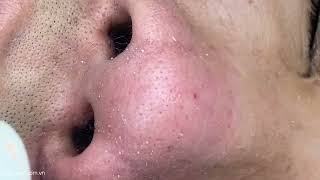 Big Cystic Acne Blackheads Extraction Blackheads amp Milia Whiteheads Removal Pimple Popping [upl. by Alenoel]