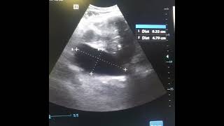 female40years paralytic ileus secondary to myomectomy [upl. by Solegna]