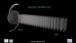 Comparison of 3 Diffractive IOLs in 3 Wavelengths Bifocal EDOFTrifocal [upl. by Enileuqaj]