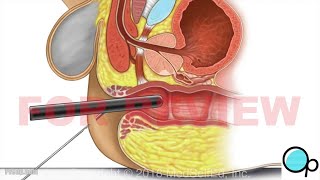 PreOp® Transrectal Ultrasound and Prostate Biopsy  Patient Education [upl. by Yoo875]