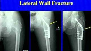 Peritrochanteric Fractures DHS Vs IM Nail [upl. by Plato]