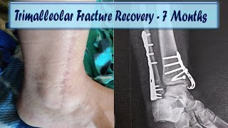 Ankle Fracture Treatment  Recovery Time amp Exercises [upl. by Linneman31]