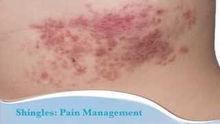 How to treat shingles [upl. by Marozas]