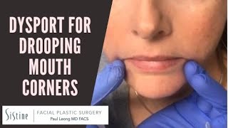 Dysport Injections to DAO Muscle for Drooping Mouth Corners [upl. by Aloin]