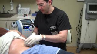 Exilis for Fat Reduction amp Skin Tightening on Stomach [upl. by Iem]