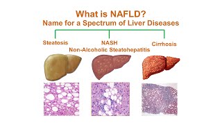 What is NonAlcoholic Fatty Liver Disease NAFLD [upl. by Darill]