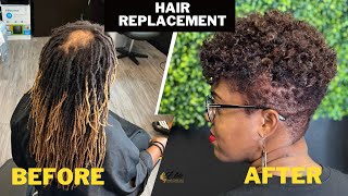 Her dreadlocks were making her bald faster Hair replacement for women female pattern baldness fix [upl. by Bayly955]