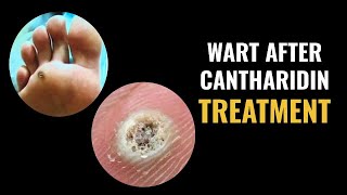 Wart After Cantharidin Treatment [upl. by Aleafar]