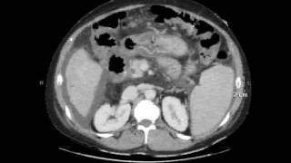 portal enteropathy [upl. by Genia]