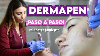 DERMAPEN  TRATAMIENTO DE MICRONEEDLING  Ximena Ramaya [upl. by Ella]