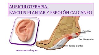 121 Fascitis plantar y Espolón calcáneo  Alivio rápido con AURICULOTERAPIA Centro IMG [upl. by Ynnelg]