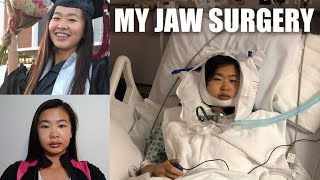 MY JAW SURGERY EXPERIENCE  LeFort I Osteotomy Day 135 of Recovery amp Tips VLOG 11  katyyho [upl. by Allerym915]