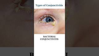 Types of Conjunctivitis pink eyes eyecareoptom pinkeye redness eyeinfection shorts short [upl. by Jared]