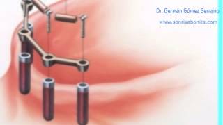 implantes dentales explicacion facil de entender  vídeo para pacientes [upl. by Aled850]