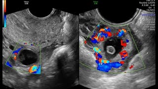 CORPUS LUTEUM VS ECTOPIC PREGNANCY [upl. by Chloe554]