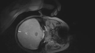 MRIGuided Injection Procedures of the Temporomandibular Joints in Children and Adults 1 of 3 [upl. by Joella]