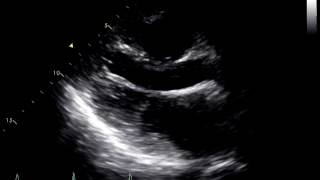 Constrictive Pericarditis Following Heart Transplant 1 [upl. by Pliam693]