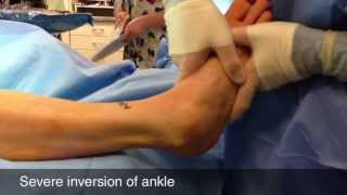 Surgery for Sprained Ankle [upl. by Asiuol]