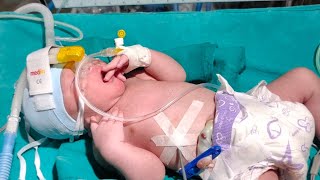 Today I Put a baby On a CPAP The child is out of danger now [upl. by Siramed]