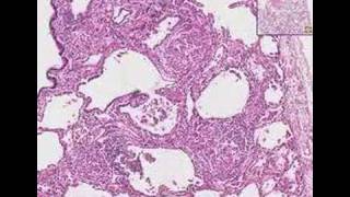 Histopathology LungSarcoidosis [upl. by Airbmac]