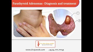 Adenomas Symptoms and Causes  Diagnosis  Treatment  Prevention [upl. by Manville]