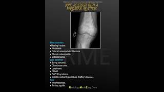 SOLITARY SCLEROTIC BONE LESION WITH A LUCENT CENTRE [upl. by Corrina]