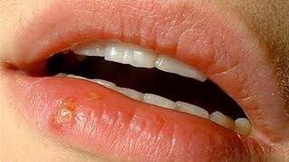 What are Cold Sores and Herpes  Malayalam [upl. by Divad]