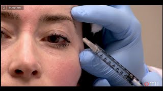 Botox Injection Links to Full Procedure [upl. by Aderf26]