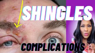 DANGEROUS Shingles Complications Postherpetic Neuralgia Ramsay Hunt Syndrome amp Zoster Opthalmicus [upl. by Atila629]