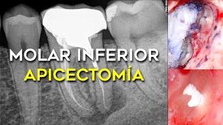 APICECTOMÍA DE UN MOLAR INFERIOR CON LIMA ROTA CIRUGÍA APICAL CERCA DEL NERVIO DENTARIO [upl. by Gower]