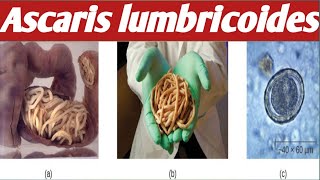 How To diagnose  Ascaris Lumbricoides [upl. by Peppel335]