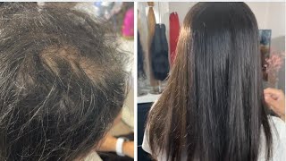 Micro Hair Topper Integration a more permanent non surgical solution for thinning hair [upl. by Vitia]