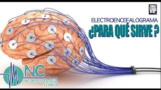 ¿Qué es el video electroencefalograma [upl. by Amapuna355]