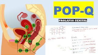 DISTOPIA  PROLAPSO GENITAL SISTEMA POPQ CON EJERCICIO [upl. by Yrocaj]