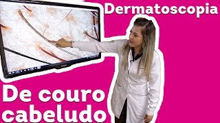 Terapia capilar  Dermatoscopia de couro cabeludo [upl. by Learsi906]