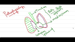 Tension Pneumothorax [upl. by Libbna]