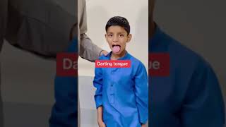 Rheumatic chorea  sydenham chorea  st Vitus dance  dr ishaq buner [upl. by Ky]