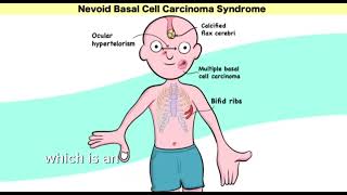 Gorlin syndrome nevoid basal cell carcinoma syndrome  Mnemonic  easy learning [upl. by Candis]