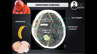 Understanding Subdural Hematoma [upl. by Sinegold65]