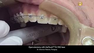 Operculectomy with LiteTouch™ ErYAG laser [upl. by Lisabeth]