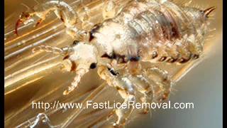 Fast Head Lice Removal [upl. by Duster]