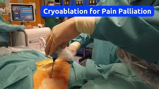 Palliative Cryoablation for Pain Management Using the ProSense™ System [upl. by Hanschen]