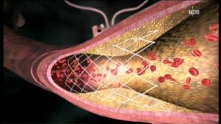 Arteriosklerose  Stent oder Bypass [upl. by Siednarb]